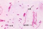 細菌性陰道炎 N76.003 細菌性陰道病 非特異性陰道炎