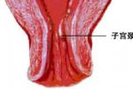 子宮內膜息肉 N84.001 