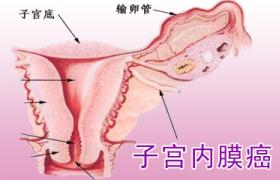 子宮內膜癌 子宮體癌 子宮癌