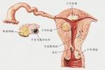 子宮內膜癌 子宮體癌 子宮癌