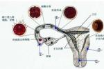 子宮內膜癌 子宮體癌 子宮癌