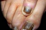 灰指甲 甲真菌病