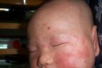 小兒濕疹 兒童濕疹 過敏性皮膚病 奶癬
