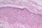 鮑溫病 癌前角化不良病 癌前皮炎 皮膚癌前期病變 皮內上皮癌 原位鱗狀細胞癌 皮膚原位癌 角結膜上皮內上皮癌