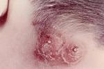 皮膚及軟組織感染 皮膚及皮膚結構感染 SSSI 皮膚及軟組織感染