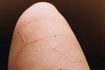 皮膚劃痕癥 人工性蕁麻疹