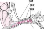 外耳炎 外耳道炎 外耳道癤 彌漫性外耳道炎
