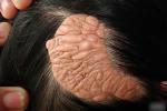 老年皮脂腺痣 器官樣痣 老年皮脂腺增生 老年性皮脂腺增生 老年性皮