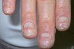真菌性甲溝炎 指尖邊緣指甲有凹陷 真菌感染 膿腫