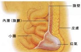 疝氣