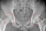 兒童股骨頭壞死 股骨頭骨骺軟骨炎或扁平髖 Legg-Calve’- Perthes綜合征