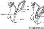 小兒腹股溝斜疝