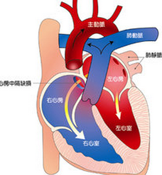 小兒房間隔缺損