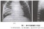 小兒膿胸 小兒化膿性胸膜炎