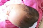 新生兒頭顱血腫