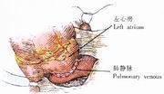 小兒部分性肺靜脈異位連接 小兒肺靜脈部分性連結異常 小兒部分肺靜脈異位連接