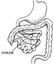 小兒腸旋轉不良