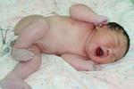 新生兒皮下壞疽 R02.X02 新生兒皮下急性蜂窩織炎