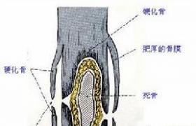 小兒慢性骨髓炎