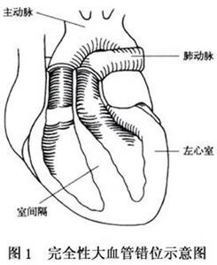 小兒大動脈轉位 小兒大動脈錯位
