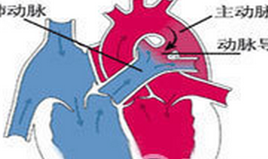 小兒動脈導管未閉 小兒主肺動脈間隔缺損 小兒開放性動脈導管