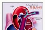 小兒動脈導管未閉 小兒主肺動脈間隔缺損 小兒開放性動脈導管