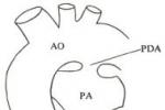 小兒動脈導管未閉 小兒主肺動脈間隔缺損 小兒開放性動脈導管