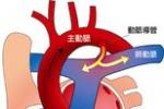 小兒動脈導管未閉 小兒主肺動脈間隔缺損 小兒開放性動脈導管