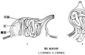臍膨出 羊膜疝 突臍 臍心 臍突出 臍帶疝