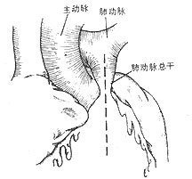 肺動脈瓣狹窄 單純肺動脈口狹窄