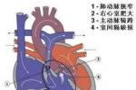 肺動脈瓣狹窄 單純肺動脈口狹窄