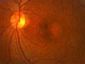 早產兒視網膜病變 晶狀體後纖維增生癥 晶體後纖維膜增生癥