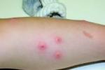 小兒色素蕁麻疹 小兒類黃瘤 小兒良性泛發性皮膚肥大細胞增