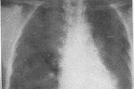 新生兒肺不張 P28.101 新生兒原發性肺膨脹不全 肺萎陷