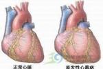 小兒擴張型心肌病 小兒充血型心肌病