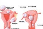 子宮性不孕 Uterine sex infertility