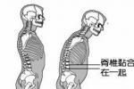 強直性脊柱炎 M45.X91 AS 類風濕性脊柱炎 畸形性脊柱炎 強直型脊柱炎