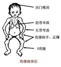 佝僂病 BEZ161 維生素D缺乏性佝僂病