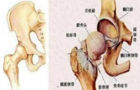 股骨頭壞死 維生素D缺乏性佝僂病