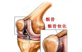 髕骨軟化癥 髕骨軟骨軟化癥髕骨軟骨炎