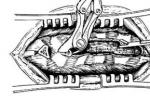 椎管狹窄 M48.091 椎管窄