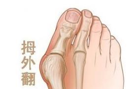 拇外翻 拇外翻畸形 hallux valgus