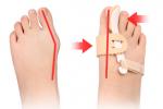 拇外翻 拇外翻畸形 hallux valgus