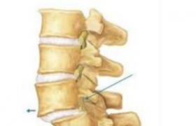 腰椎滑脫 腰椎穿刺後頭痛