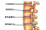 腰椎滑脫 腰椎穿刺後頭痛