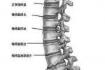 腰椎滑脫 腰椎穿刺後頭痛