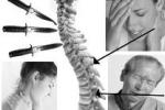 脊髓型頸椎病 M47.121+ 頸型頸椎病神經根型頸椎病脊髓型頸椎病椎動脈型頸椎病交感神經型頸椎病食管壓迫型頸椎病。