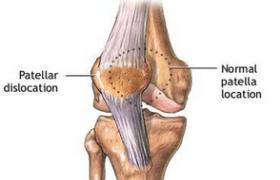 髕骨脫位 S83.001 髕骨脫位 習慣性髕骨脫位