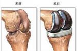 髕骨脫位 S83.001 髕骨脫位 習慣性髕骨脫位