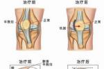 髕骨脫位 S83.001 髕骨脫位 習慣性髕骨脫位